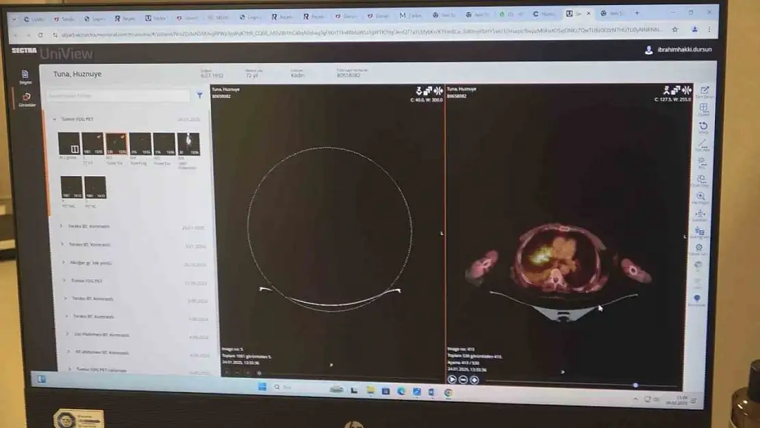 Beslenme biçimi ve yaşam tarzı kanser hastalığını tetikliyor