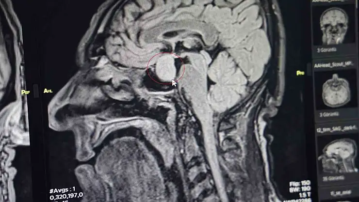 Diyarbakır Gazi Yaşargil Eğitim ve Araştırma Hastanesinde ilk kez kapalı yöntemle beyindeki tümör alındı